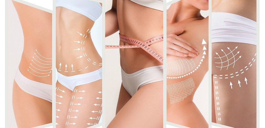 Postoperative Corset vs Waist Trainers in Rib Removal Waistline