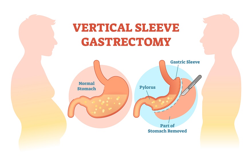 weight loss surgery journey vertical gastric sleeve